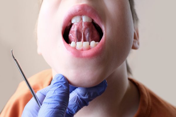 Frenulectomia: intervento per risovere problemi di frenulo corto