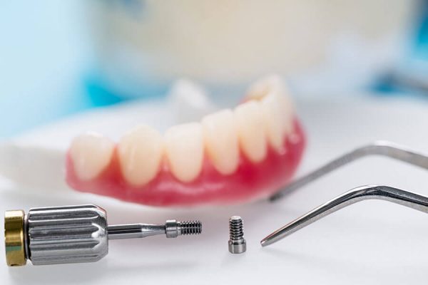 Overdenture con barra su impianti, la soluzione per un sorriso stabile